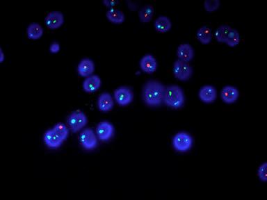 Analisi di aneuploidie nello sperma Analisi di aneuploidie nello sperma